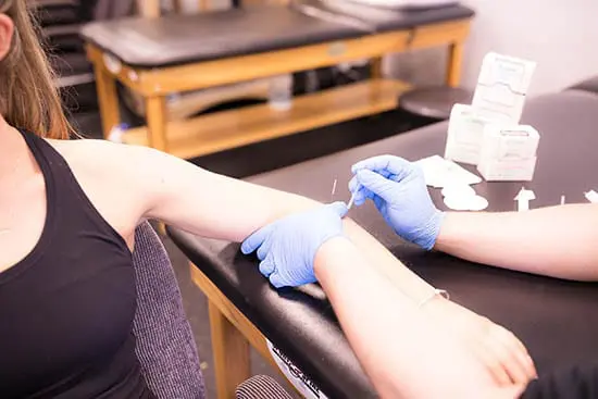 Unlocking Pain Relief: The Power of Dry Needling Explained by a Physical Therapist